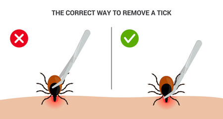 The correct way to remove a tick insect correctly. Tips for tick safety infographic © metel_m