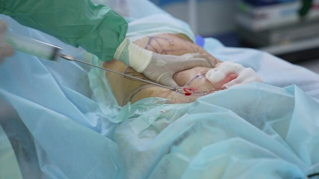 Surgeon's hands collects fat into pipe. Liposuction procedure for improvement patient's body. Medicine concept. Close-up.