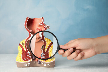 Doctor with magnifying glass showing model of unhealthy lower rectum on light blue background, closeup. Hemorrhoid problem