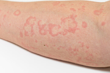 蕁麻疹の症状
