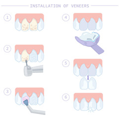 Dental treatment and care. Installation of veneers, stages of work. Instructions for dentists. Vector illustration for dentistry textbooks.