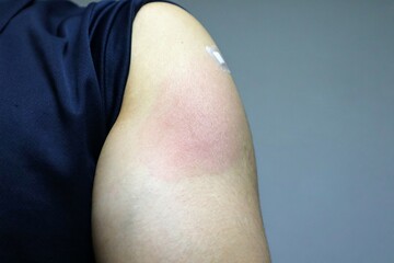 Fototapeta premium コロナワクチン接種後に副反応で腕が赤くなった人物