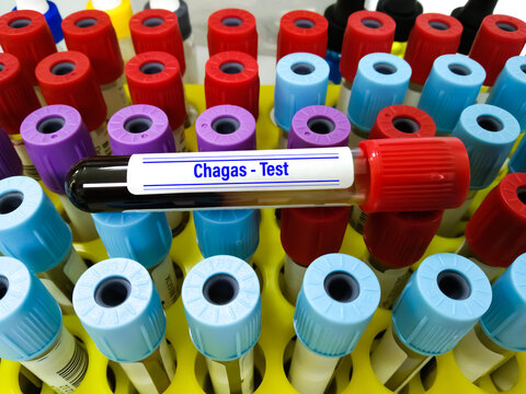 Blood Sample For Chagas Disease (American Trypanosomiasis) Test