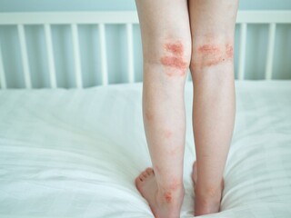 Eczema on kid's legs. Atopic dermatitis close up. Allergy spots and red itchy skin inflammation on child's feet - obrazy, fototapety, plakaty