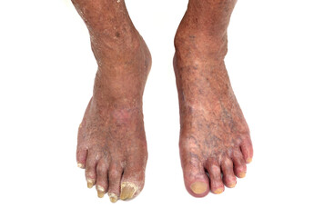 Feet of a very old man with long and damaged nails and dry skin before and after pedicure...