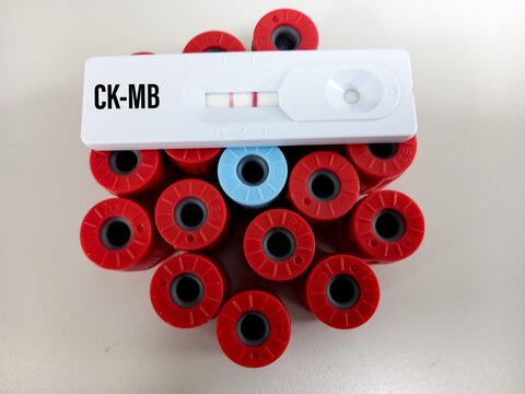 CK MB testing by using rapid test cassette, the result showed positive, myocardial infarction (MI) diagnosis