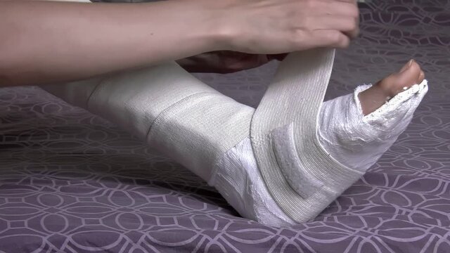 Removal of the elastic bandage from the leg. Leg in plaster bandage. High quality FullHD footage. 50 FPS, downscaling.