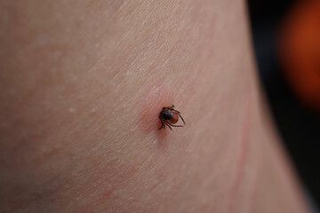 Close up of sucking female tick on human irritated skin. Bloated Ixodes ricinus dangerous parasite...
