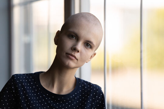 Head Shot Portrait Of Young Millennial Woman With Shaved Head Suffering From Oncological Disease. Cancer Patient Taking Chemotherapy, Radiotherapy Against Leukemia, Brain Tumor, Fighting For Life