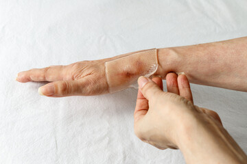 Applying a special medical self adhesive silicone gel sheet  to a healing scar after tendon surgery...