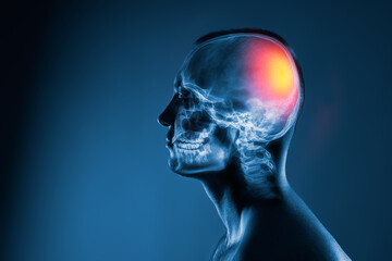 X-ray of a man's head on blue background. Medical examination of head injuries. Cerebral stroke. The back of the brain is highlighted yellow red colour. Others x-ray images in my portfolio.