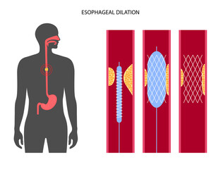 Esophageal dilation procedure - obrazy, fototapety, plakaty