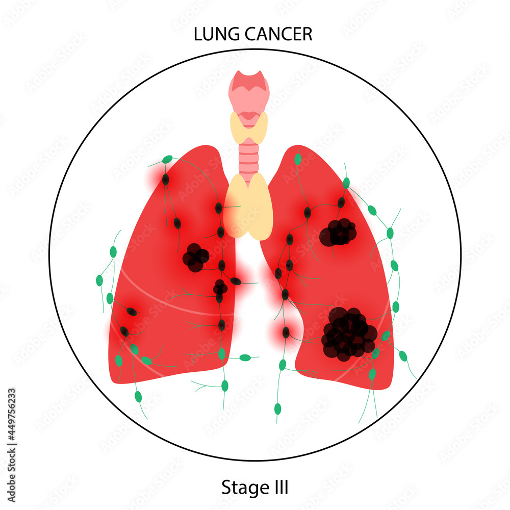 Wall mural Lungs cancer disease