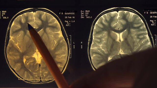 Magnetic resonance imaging (mri) of the human brain. Closeup. Macro