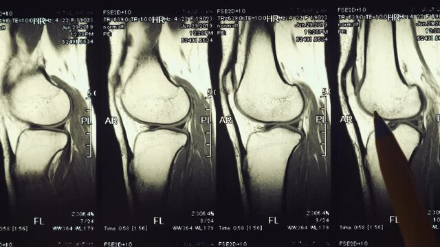 Magnetic resonance imaging (MRI) of the knee joint. Closeup. Macro