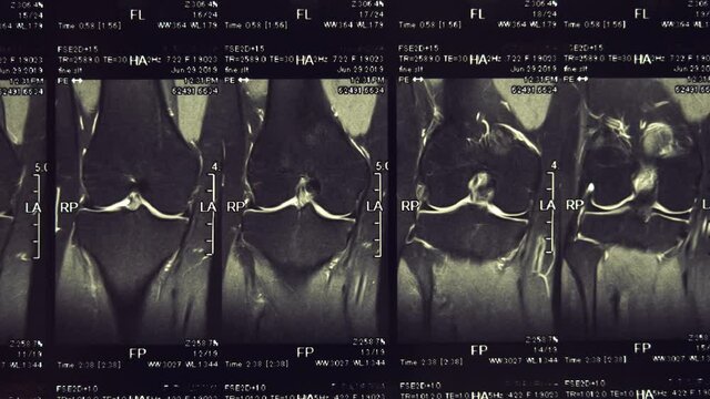 Magnetic resonance imaging (MRI) of the knee joint. Closeup. Macro