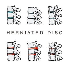 Illustration for the Spine Clinic. Bone structure and herniated discs and degeneration.