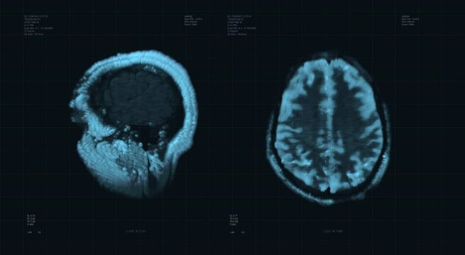 Brain scan visualization animation. Diagnosis data on laboratory display. Human illness research. Special medical equipment for tumor testing. Neurology test. X-ray. Tomography MRI, CT head examining
