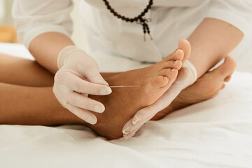 Chiropractor doing acupuncture therapy for female feet with needles. Acupuncture treatment for chronic foot pain