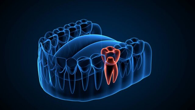 Jaw with implants supporting dental bridge with x-ray effect over dark blue background