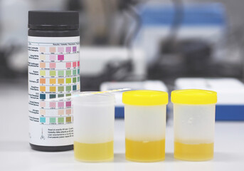Hand in blue glove holding urine strip test  for urinalysis used to be routine during check-ups, typically to test for traces of blood, protein, or sugar.