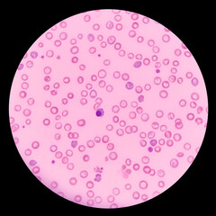 Under a microscope show the red blood cells have less color than normal. A blood smear showing...