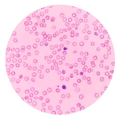Under a microscope show the red blood cells have less color than normal. A blood smear showing...