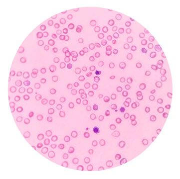 Under a microscope show the red blood cells have less color than normal. A blood smear showing hypochromic anemia, the increased central pallor of the red blood cells.