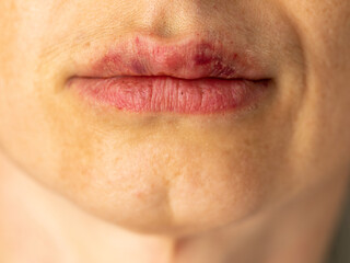 Beautiful middle aged woman with a bruise on her lips after lip augmentation with hyaluronic acid....