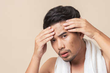 Facial health problems of men. Young adult Asian man worry have blemish on face caused by acne....