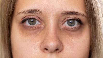 Cropped shot of a young woman's face. Green eyes with dark circles under the eyes and with red...