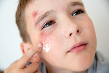 Close-up of the boy's face with a sadina. The child treats the wound on the face.