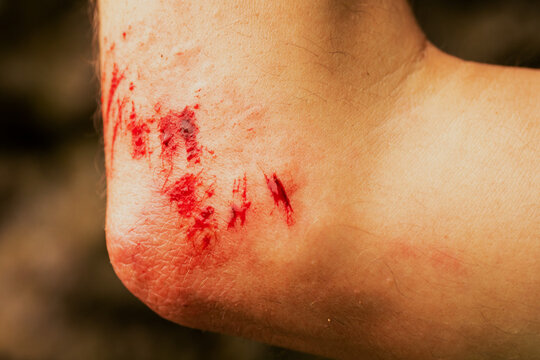 Fresh bleeding wound caused by falling on a hard rocks in a mountain