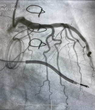 X ray image perform prosthetic heart valve, staples, steel suture and Left coronary artery angiogram