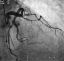 coronary angiogram (CAG) was showed chronic total occlusion (CTO) at mid part of left anterior...