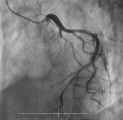 coronary angiogram (CAG) was showed chronic total occlusion (CTO) at mid part of left anterior descending artery (LAD) 