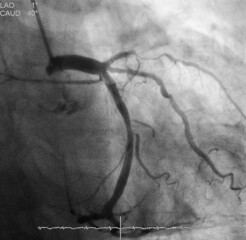 coronary angiogram (CAG) was showed chronic total occlusion (CTO) at mid part of left anterior descending artery (LAD) 