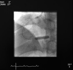 x ray image perform balloon catheter inflation at right coronary artery in percutaneous coronary intervention (pci) procedure