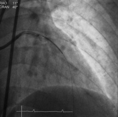 coronary angiogram (CAG) was performed percutaneous coronary intervention (PCI) at proximal to mid...