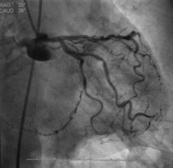 Coronary artery angiogram (CAG) of left coronary artery stenosis 