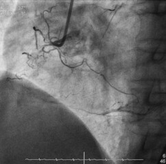 coronary angiogram was performed chronic total occlusion (cto) at mid right coronary artery (rca)