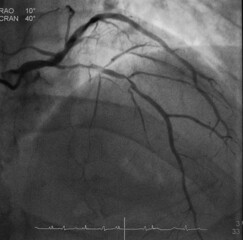 coronary angiogram (CAG) was performed mid part of left anterior descending artery (lad) stenosis