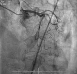 coronary angiogram (CAG) was performed normal left coronary artery (lca)