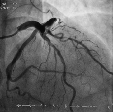 coronary angiogram (CAG) was showed left anterior descending artery (LAD) stenosis