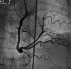 The coronary artery angiography (cag) was performed normal right coronary artery (rca).