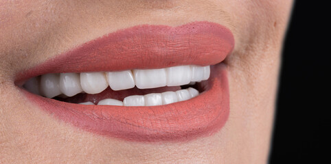 press ceramic crowns and veneers