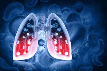 Virus and bacteria infected the Human lungs, lung disease, 3d illustration
