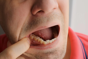 Man is showing tooth in mouth with a dental abscess fistula on gum, closeup view. Tooth with a temporary filling seal. Caries dental concept. Dental treatment of the internal parts of the tooth. - obrazy, fototapety, plakaty