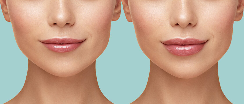 Comparison of female lips before and after augmentation. Cosmetology and beauty injections.