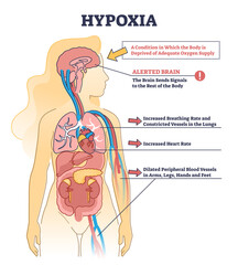Hypoxia condition as lack of oxygen in brain cells or tissues outline diagram. Labeled medical description with disease symptoms and educational process scheme vector illustration. Hypoxemia disease.